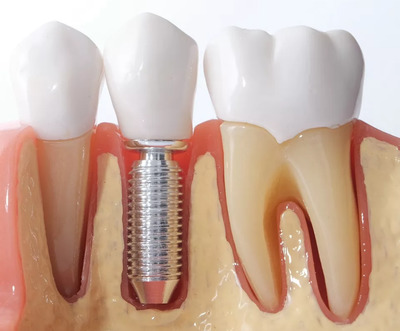 Имплантация зубов изменила мою жизнь